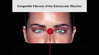 21  Special Forms of Strabismus   Animated Book   Binocular Vision and Ocular Motility