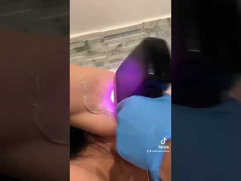 Laser hair removal of the underarms 🥰 #satisfying #satisfyingvideo #hairremoval