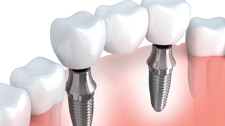 FAQ - I hate my partial dentures! What else can I do? | Dr. Ron Richardson