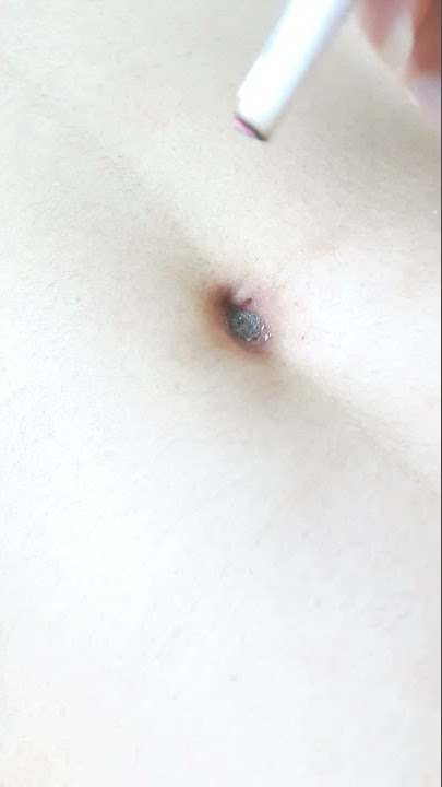 belly button cigarette torture 1