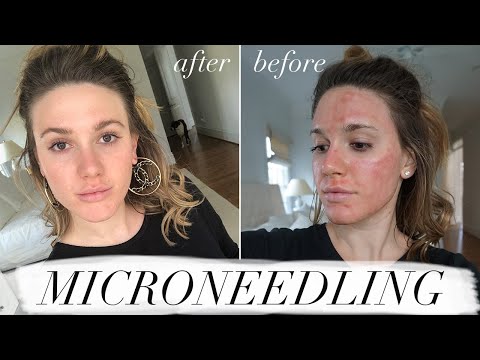 MY FIRST MICRONEEDLING EXPERIENCE & WHAT TO EXPECT //ACNE SCAR TREATMENT
