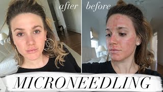 MY FIRST MICRONEEDLING EXPERIENCE & WHAT TO EXPECT //ACNE SCAR TREATMENT