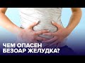 БЕЗОАР или что можно обнаружить в нашем желудке?