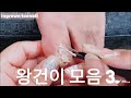 [시원함주의!!]👣😏역대급 왕건이만 모아모아 3탄!!Ingrown Toenail Collection!!