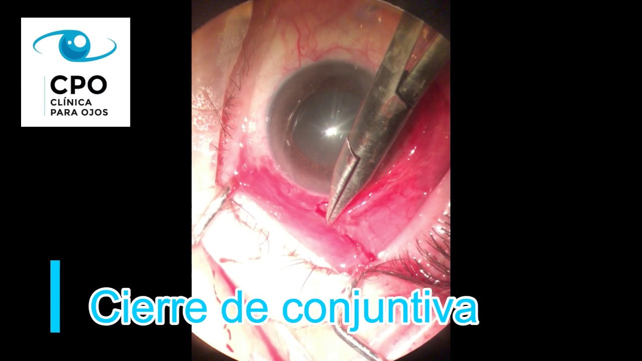 Operacion De Glaucoma En El Ojo Colocación de Válvula para Glaucoma. Clínica Para Ojos. - YouTube