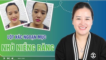 Tháo mắc cài niềng răng khớp cắn ngược (móm) thay đổi nụ cười ở tuổi 30