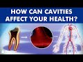 Cavities and the influence of tooth decay on health ©