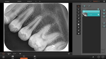 3DISC QuantorDent Imaging Software Intro