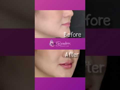 Suntik Filler Bibir Before After, Melembabkan Mengurangi Kerutan