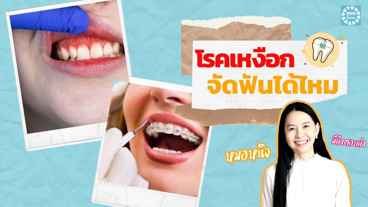ฟันไม่สวย เป็น โรคเหงือก เหงือกอักเสบ เหงือกร่น จัดฟันได้ไหม - Youtube
