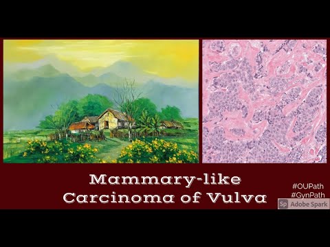 Mammary-like Carcinoma of Vulva