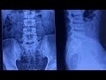 X-ray of Lumbo-Sacral Spine (both view) || Part-1 || Bangla Description || Viva Question