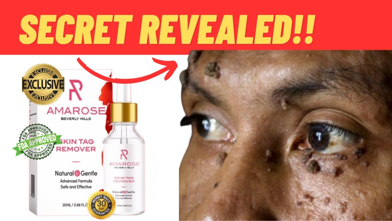 AMAROSE SKIN TAG REMOVER REVIEW THE TRUTH Does Amarose Skin Tag AMAROSE SKIN TAG REMOVER REVIEW THE TRUTH Does Amarose Skin Tag