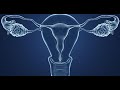 comment guerir de la dystrophie ovarienne