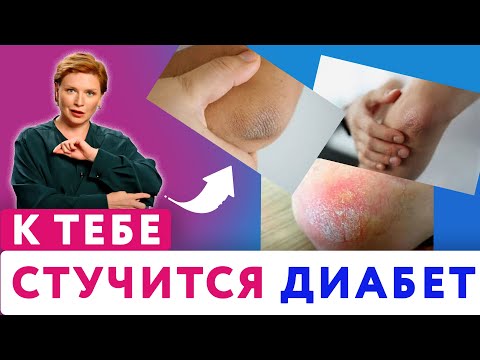 Почему ЛОКТИ СУХИЕ и шершавые // Причины сухих локтей