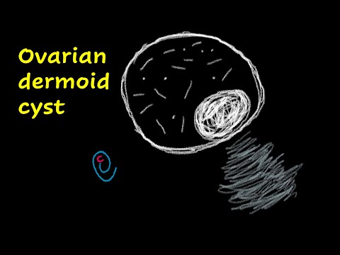 Ovarian dermoid cyst