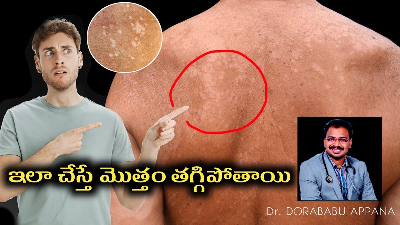 చర్మంపై  మచ్చలు  | solve skin problem | tinea versicolor | pityriasis versicolor | treatment Telugu