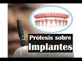 PROTESIS DENTALES SOBRE IMPLANTES - PRODENT