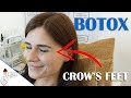 Botox For Crow's Feet | Full Procedure With Results