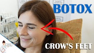 Botox For Crow's Feet | Full Procedure With Results
