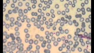 P.malariae in thin blood film using Webscope
