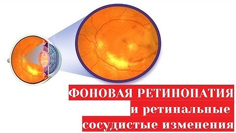 Фоновая ретинопатия 👀 и ретинальные сосудистые изменения сетчатки. Причины и лечение.