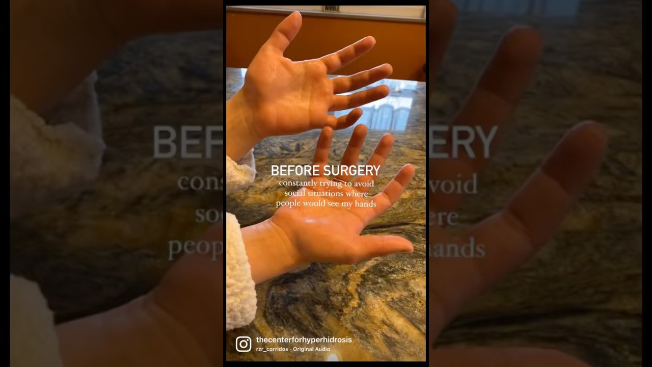 Life before and after surgery for excessively sweaty hands 