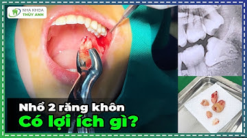 Trực Tiếp Nhổ 2 Răng Khôn Cùng Lúc - "Đau" Một Lần Rồi Thôi