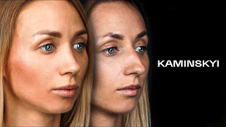 Rhinoplasty Before and After. Nose Job Result. Nose surgery / KAMINSKYI