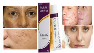 Glyco 6 cream/ glycolic acid / Remove Redness/ hyper pigmentation /pimples marks/Acne / scars //