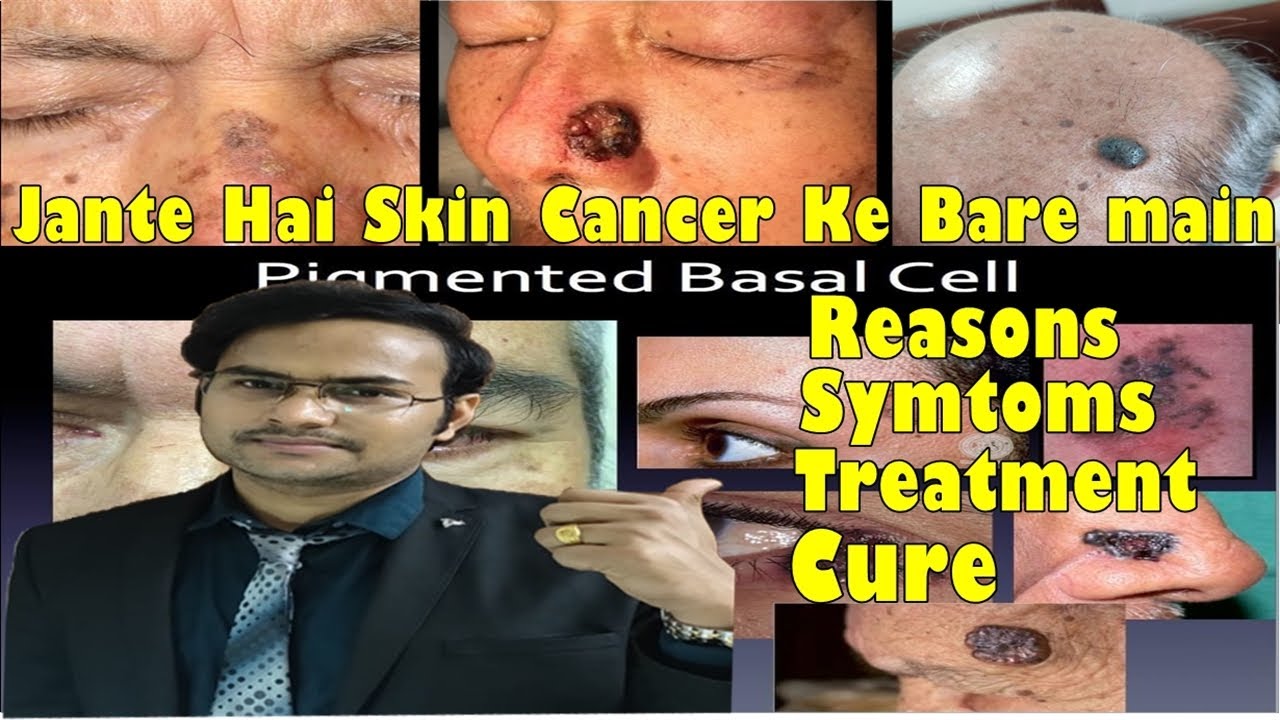 What is Basal cell carcinoma and treatment/BCC kya hota he aur iska ilaz?Dr Uttam Kumar Lenka