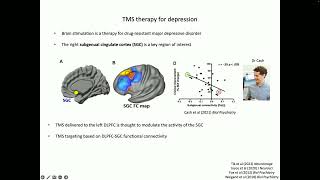 OHBM 2025 | Symposium | Caio Seguin | Unveiling the neuroanatomical basis of antidepressant TMS us…