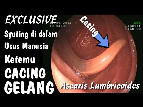 Simak juga pemeriksaanSimak juga pemeriksaanEndoscopySimak juga pemeriksaanSimak juga pemeriksaanEnd. 