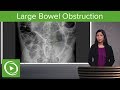 Bowel Obstruction and Ileus: Large Bowel Obstruction & Ogilvie Syndrome – Radiology | Lecturio