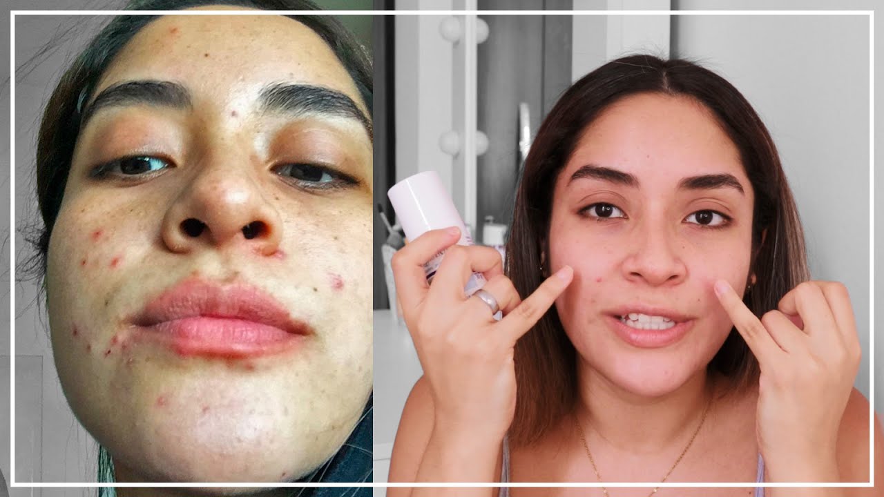 aviclear-laser-for-acne-my-before-and-after-results-realself-news