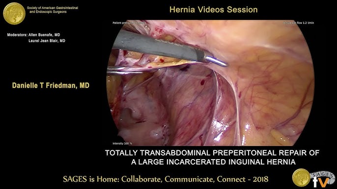 Inguinal Hernia Repair Surgery Patient Information from SAGES