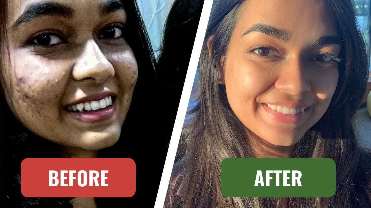 How I FINALLY Cleared My Acne - YouTube