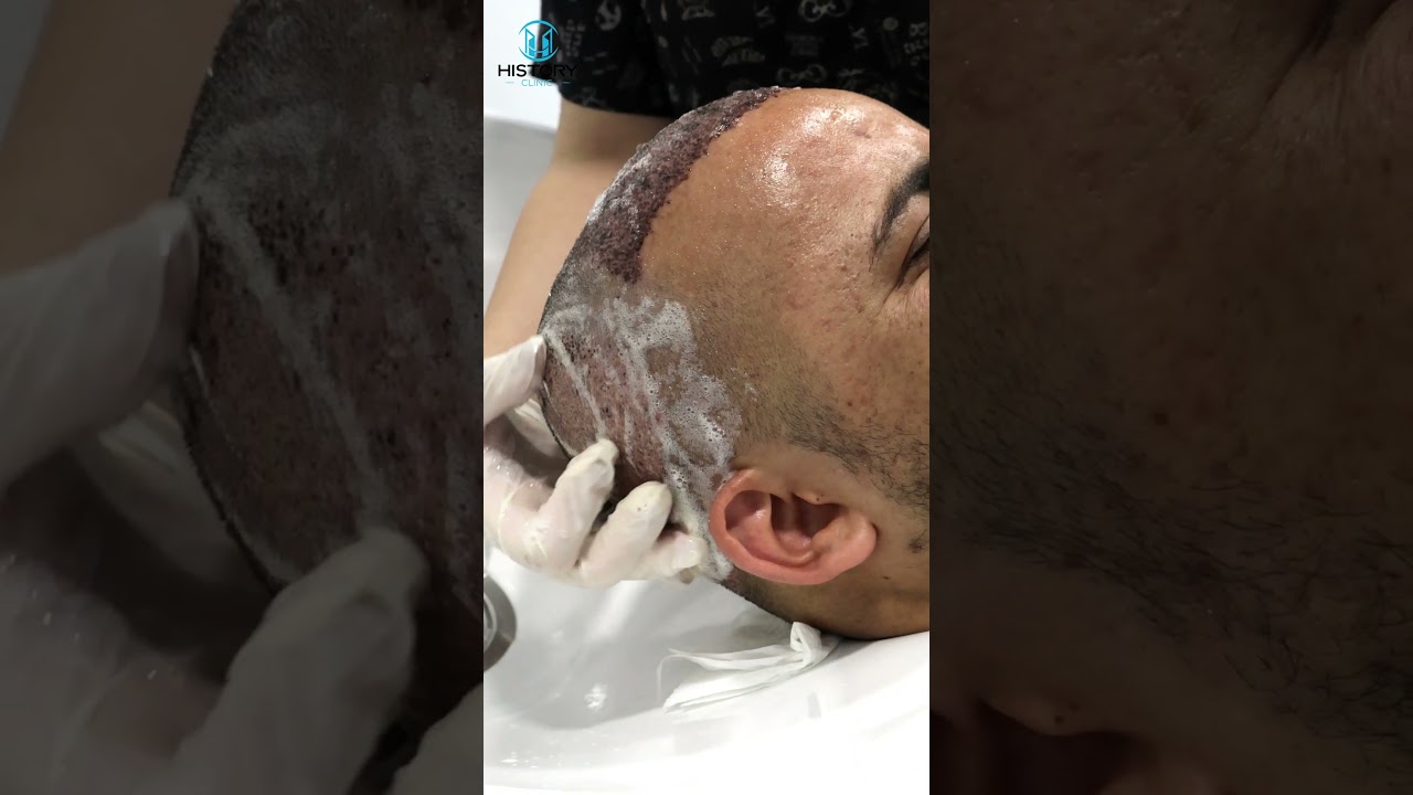 Saç ekimi yıkaması