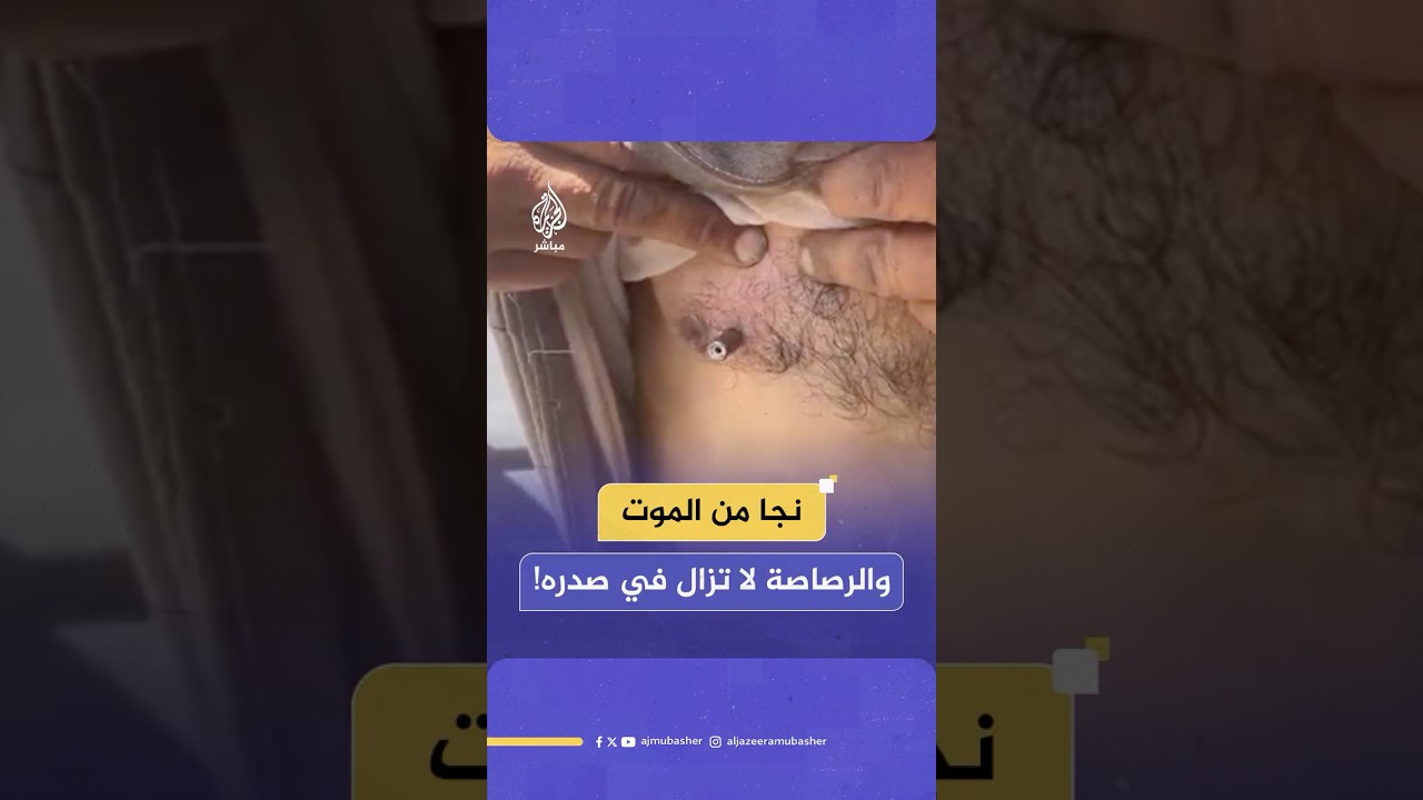 الطلق الناري لا يزال في صدره.. فلسطيني ينجو من الموت أثناء انتظاره الحصول على مساعدات إنسانية في غزة