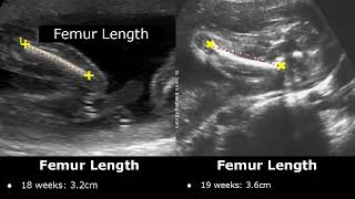 Femur Length Ultrasound Normal Values | Femoral Length Measurements | Fetal Biometric Parameters USG screenshot 3