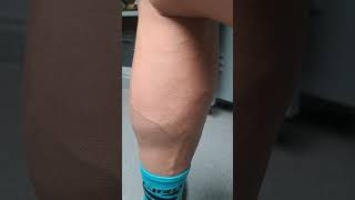 Leg Muscle fibres twitching after cycling race