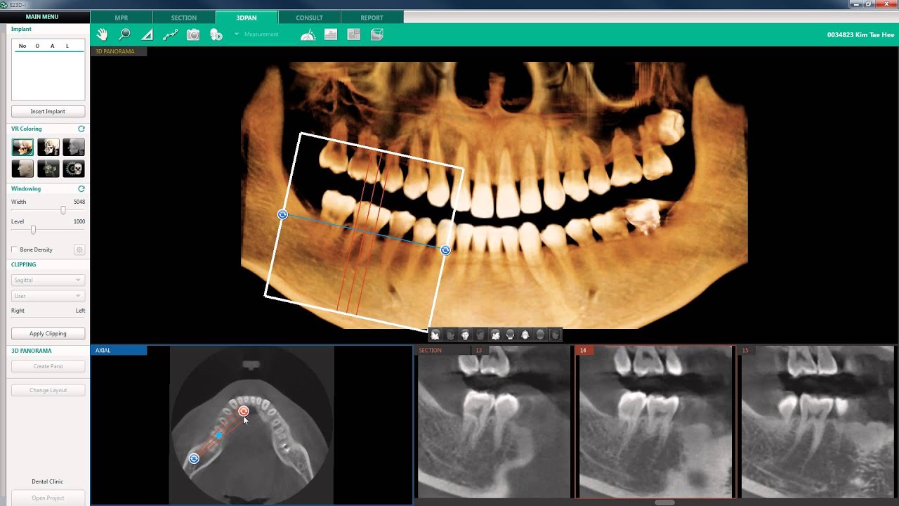 Ez3d2009. Кт зубов VATECH. VATECH ez3d-i. Компьютерный томограф VATECH Pax-i3d с цефалостатом. Компьютерная томография челюстей VATECH.
