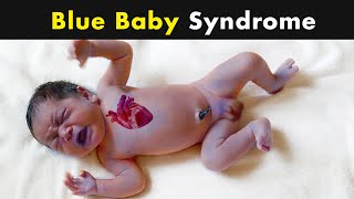 Cyanosis - Blue Skin Color in babies | Symptoms, Causes and Treatment (Urdu\/Hindi)