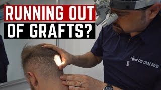 Am I running out of grafts!? Consultation with HLC!