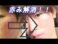 【ニキビ跡 赤ら顔】顔の赤みを圧倒的に改善してくれたヤツ