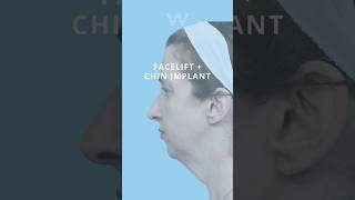 Before and after results: Facelift and Chin Implant (Augmentation) with Dr. Jeffrey B. Wis