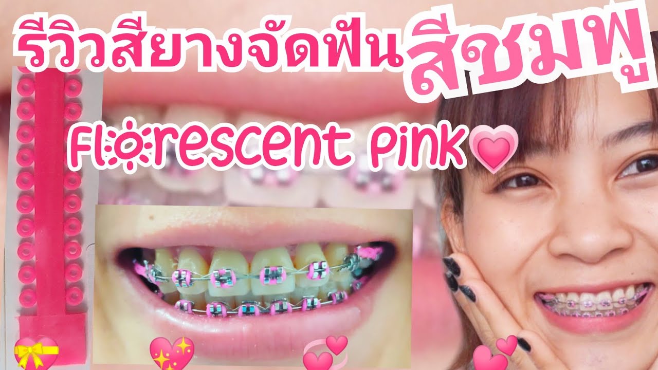 เหล็ก ดัด ฟัน สีชมพู  2022 Update  รีวิวสียางจัดฟันสีชมพู fluorescent pink?? ต้อนรับเดือนแห่งความรัก :คุยเฟื่องเรื่องจัดฟัน EP.16
