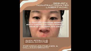 Resurfx Non-Fractionated Laser Resurfacing - Patient And Doctor Experience