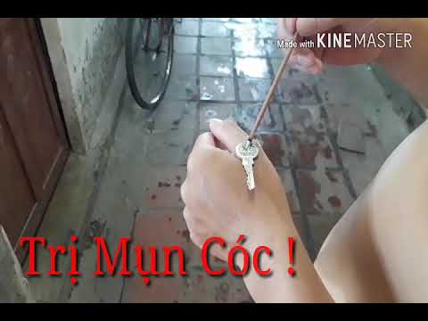 Cách chữa mụn cóc đơn giản mà hiệu quả