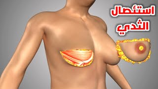 شاهد ازاي بتم عملية استئصال الثدي _ ?How Breast Cancer Surgery Is Performed